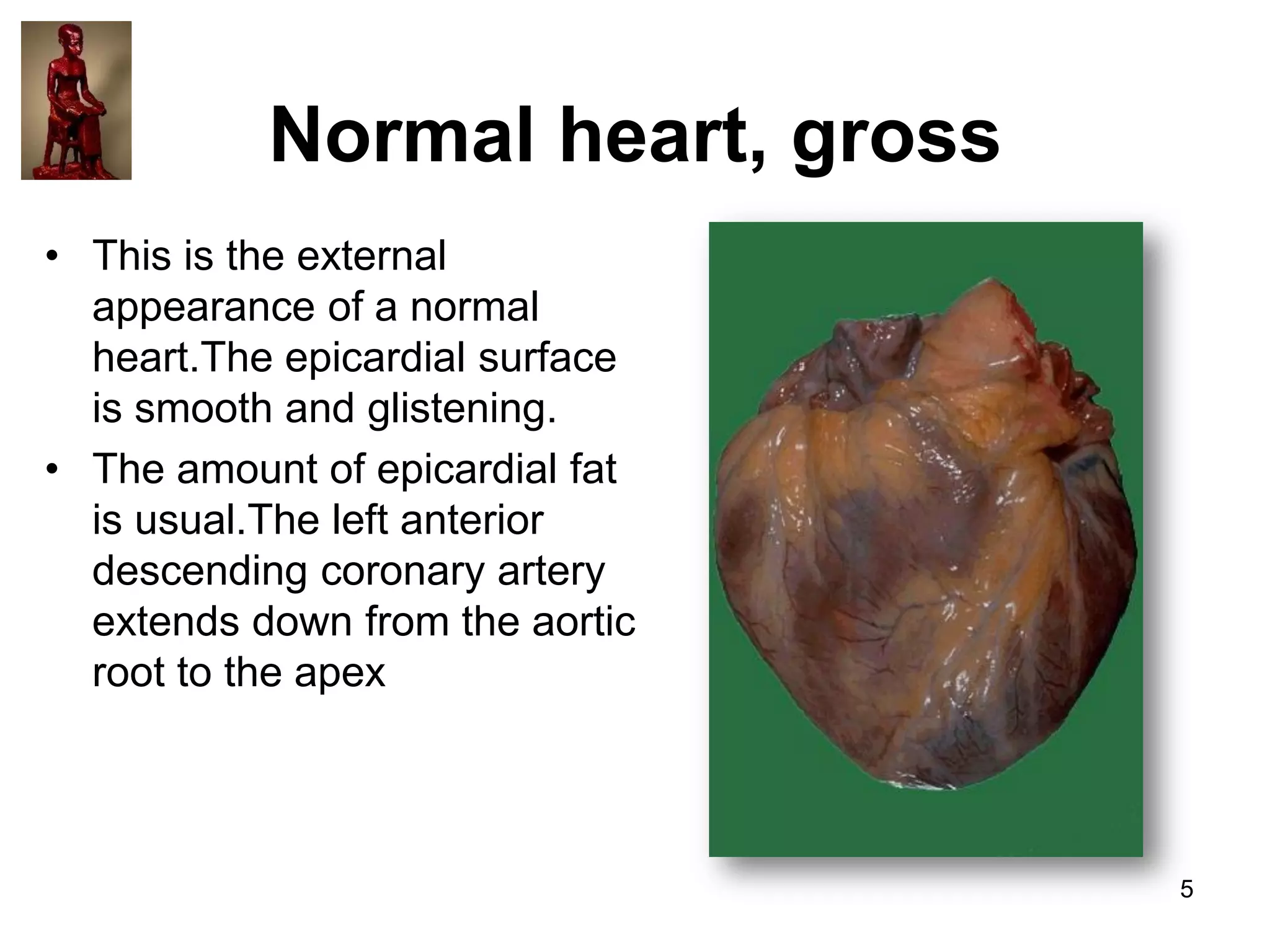 Normal heart, gross
• This is the external
appearance of a normal
heart.The epicardial surface
is smooth and glistening.
• The amount of epicardial fat
is usual.The left anterior
descending coronary artery
extends down from the aortic
root to the apex

5

 