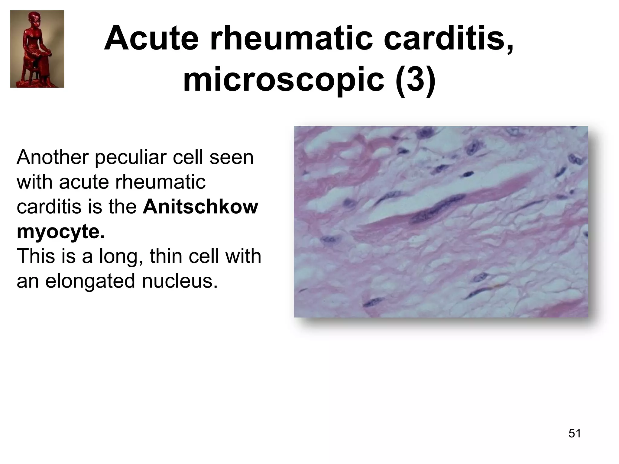 Acute rheumatic carditis,
microscopic (3)
Another peculiar cell seen
with acute rheumatic
carditis is the Anitschkow
myocyte.
This is a long, thin cell with
an elongated nucleus.

51

 