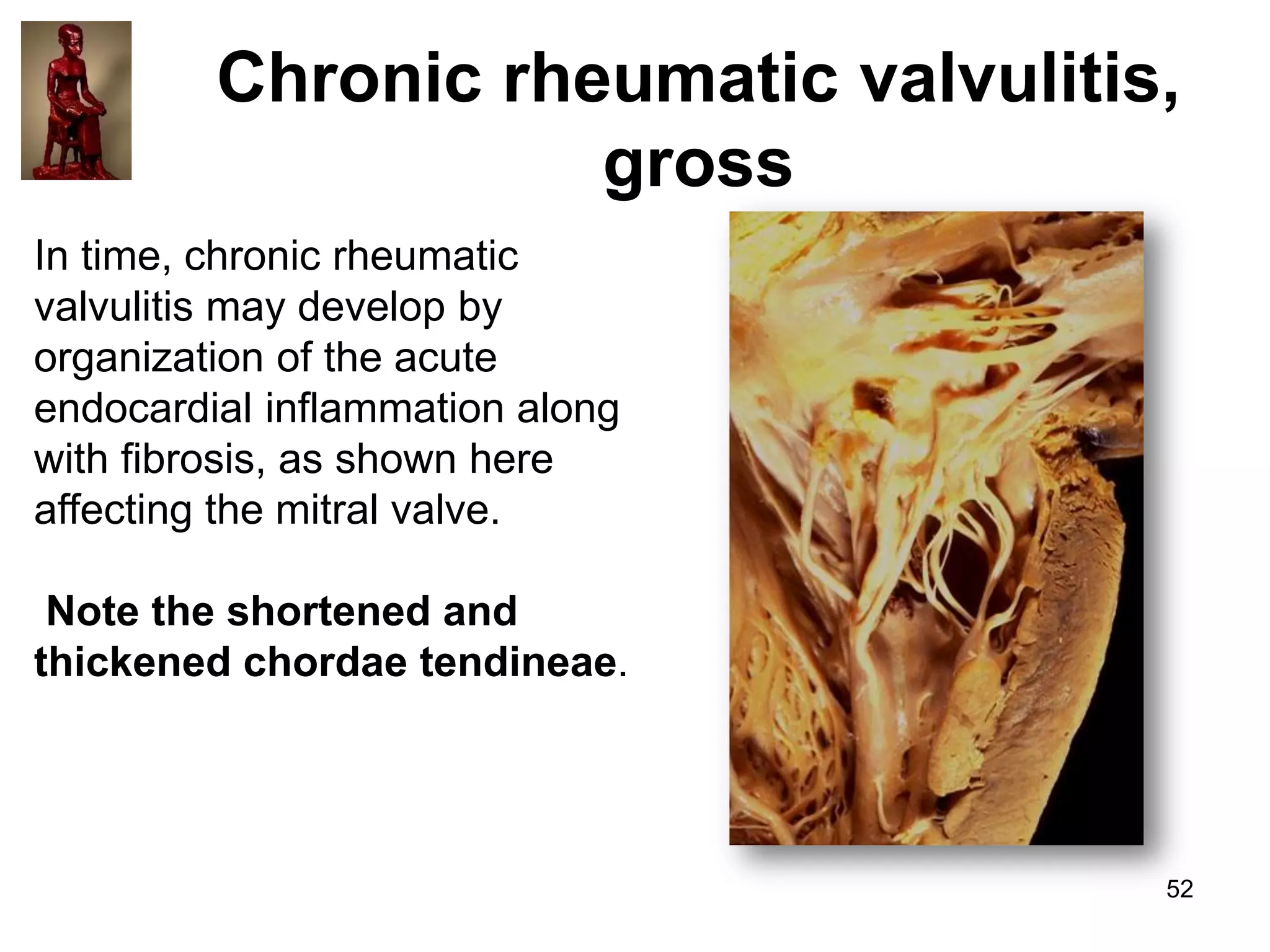 Chronic rheumatic valvulitis,
gross
In time, chronic rheumatic
valvulitis may develop by
organization of the acute
endocardial inflammation along
with fibrosis, as shown here
affecting the mitral valve.
Note the shortened and
thickened chordae tendineae.

52

 