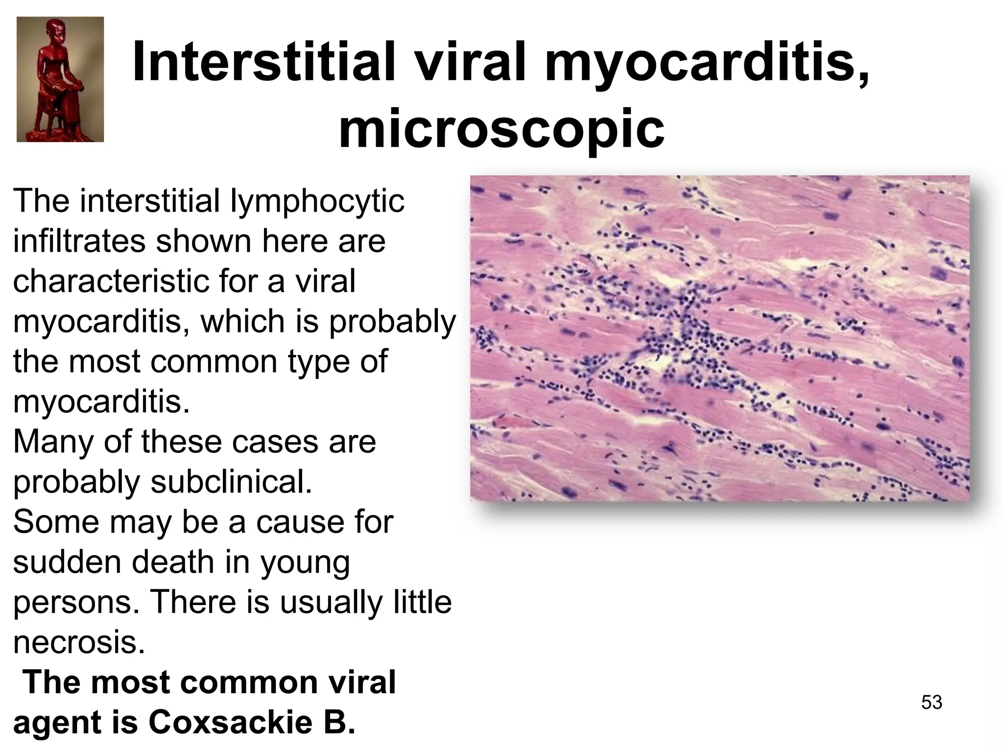 Interstitial viral myocarditis,
microscopic
The interstitial lymphocytic
infiltrates shown here are
characteristic for a viral
myocarditis, which is probably
the most common type of
myocarditis.
Many of these cases are
probably subclinical.
Some may be a cause for
sudden death in young
persons. There is usually little
necrosis.
The most common viral
agent is Coxsackie B.

53

 
