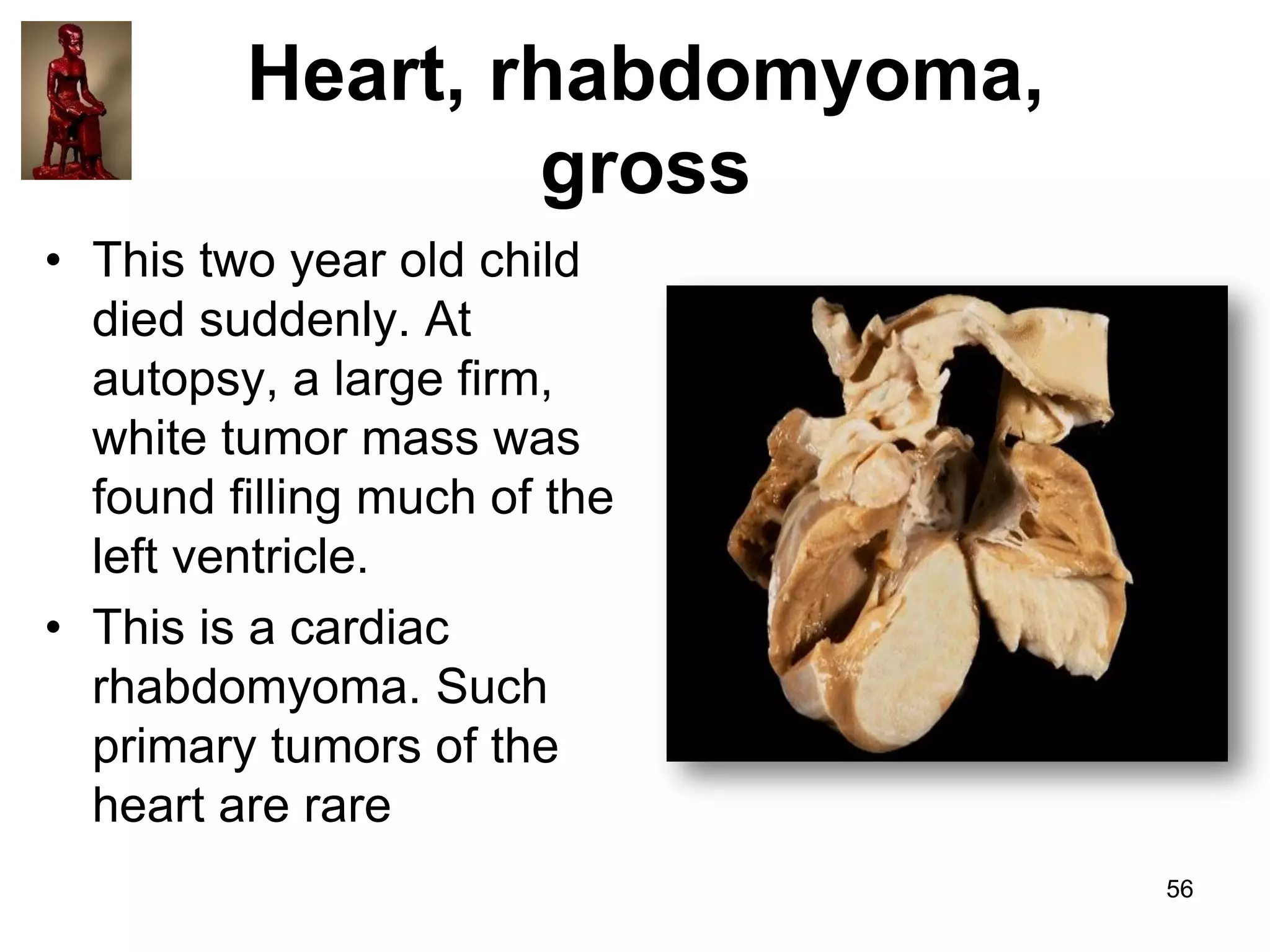 Heart, rhabdomyoma,
gross
• This two year old child
died suddenly. At
autopsy, a large firm,
white tumor mass was
found filling much of the
left ventricle.
• This is a cardiac
rhabdomyoma. Such
primary tumors of the
heart are rare
56

 