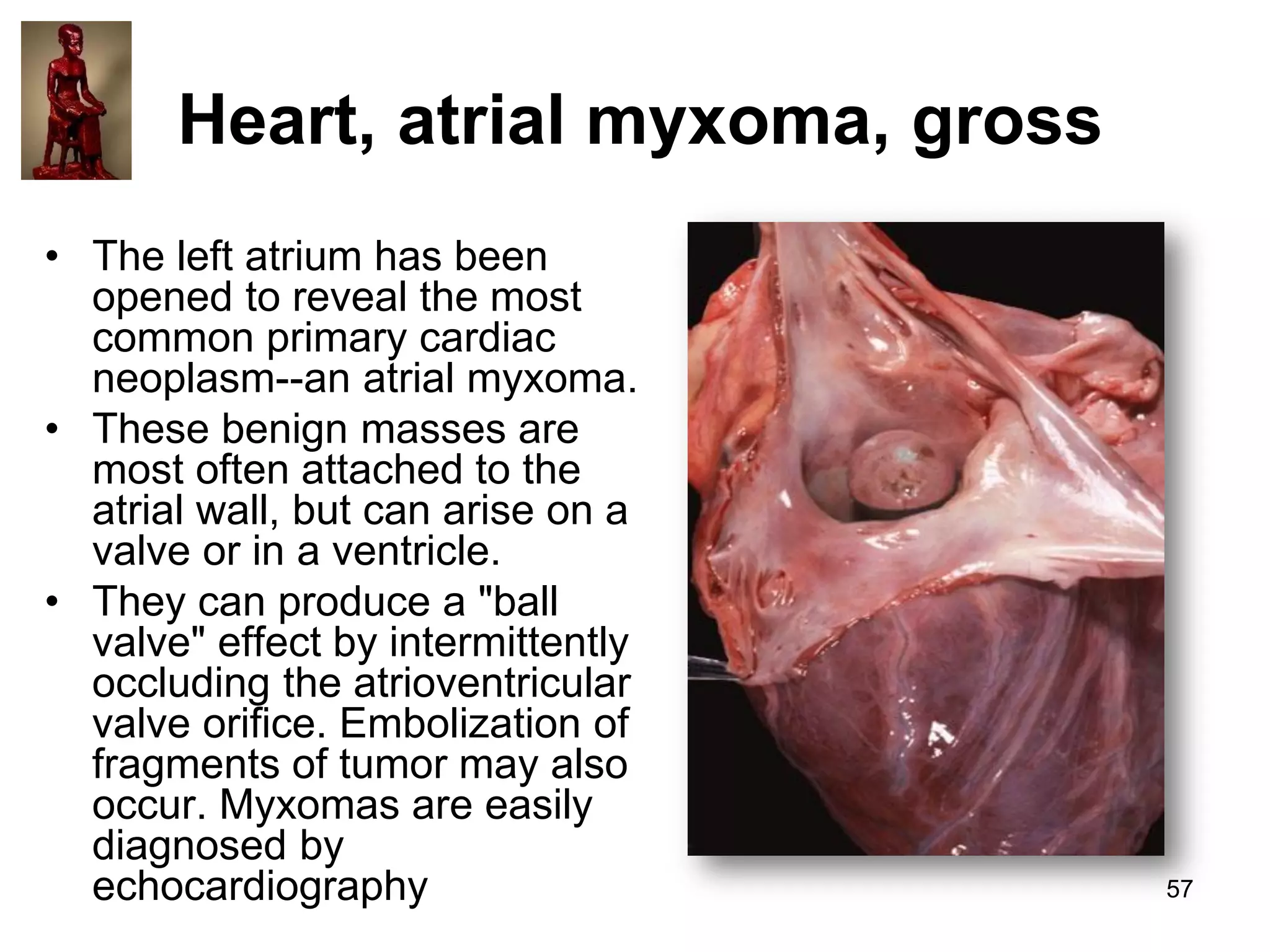Heart, atrial myxoma, gross
• The left atrium has been
opened to reveal the most
common primary cardiac
neoplasm--an atrial myxoma.
• These benign masses are
most often attached to the
atrial wall, but can arise on a
valve or in a ventricle.
• They can produce a "ball
valve" effect by intermittently
occluding the atrioventricular
valve orifice. Embolization of
fragments of tumor may also
occur. Myxomas are easily
diagnosed by
echocardiography

57

 