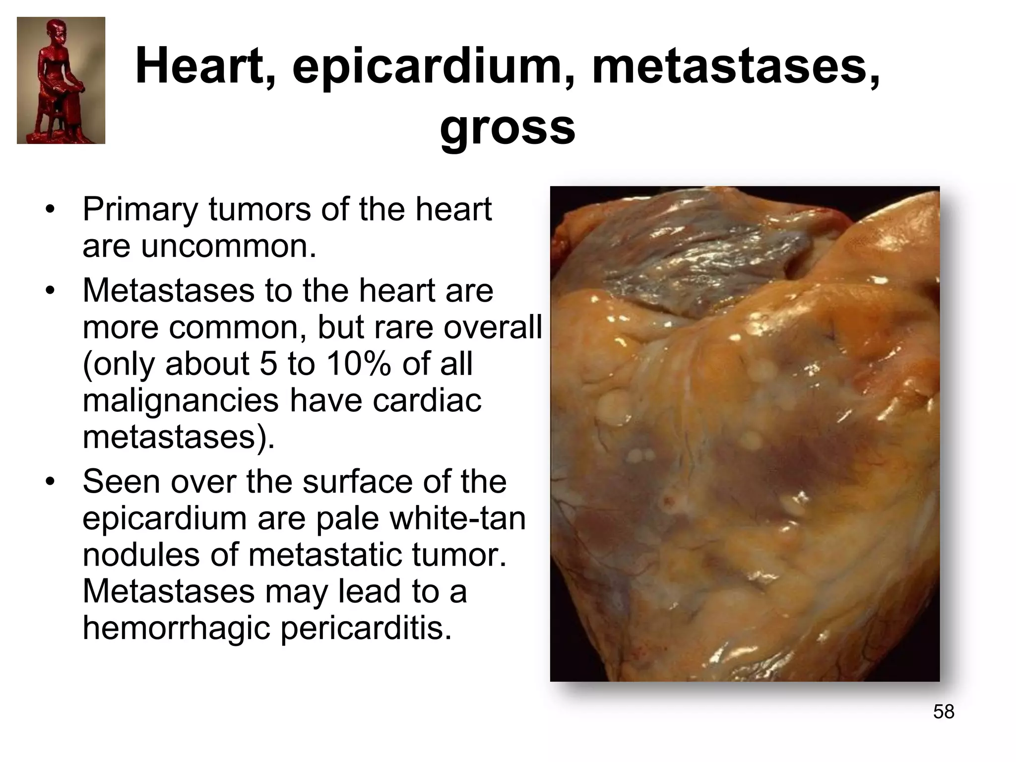 Heart, epicardium, metastases,
gross
• Primary tumors of the heart
are uncommon.
• Metastases to the heart are
more common, but rare overall
(only about 5 to 10% of all
malignancies have cardiac
metastases).
• Seen over the surface of the
epicardium are pale white-tan
nodules of metastatic tumor.
Metastases may lead to a
hemorrhagic pericarditis.
58

 