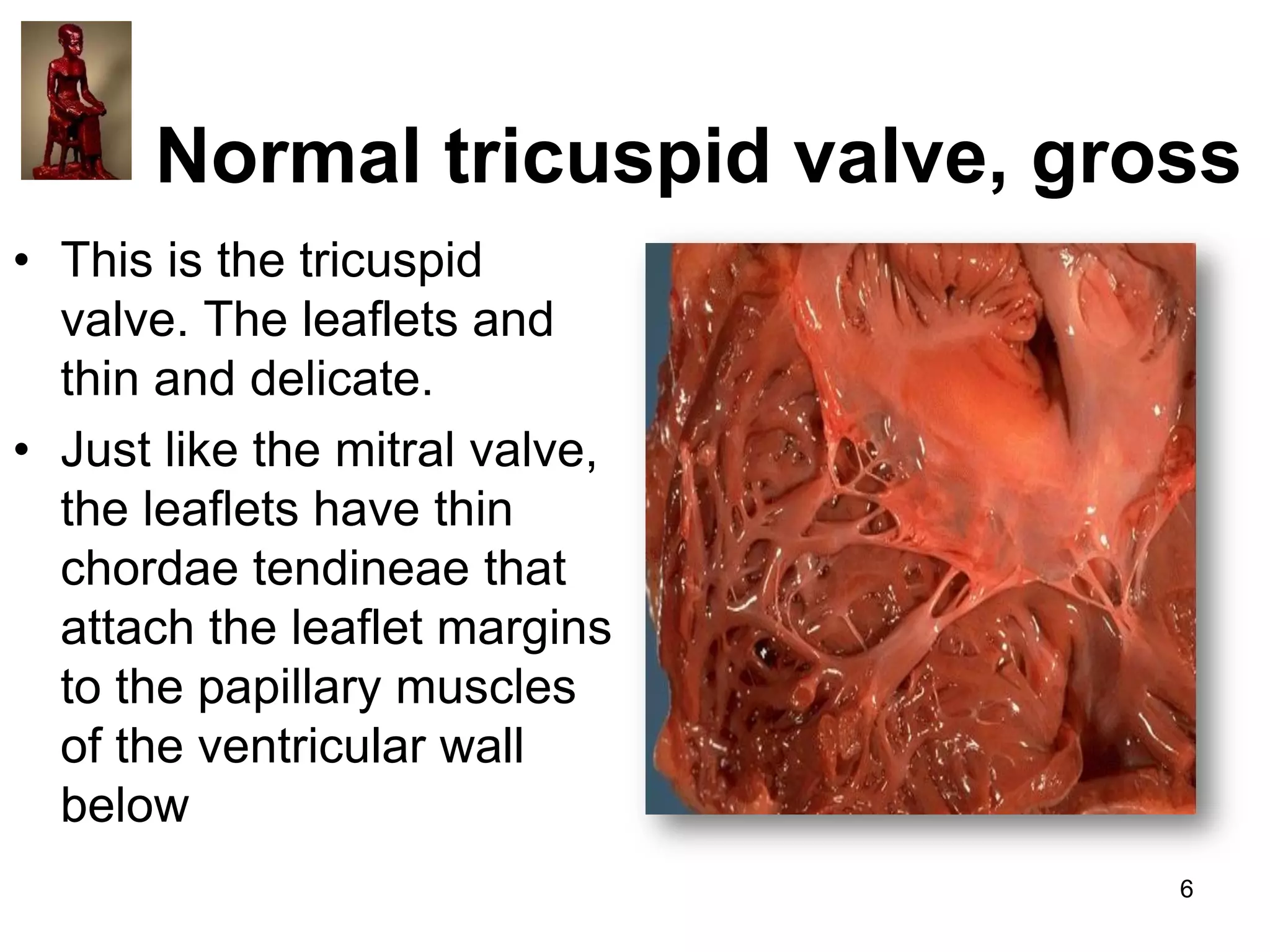 Normal tricuspid valve, gross
• This is the tricuspid
valve. The leaflets and
thin and delicate.
• Just like the mitral valve,
the leaflets have thin
chordae tendineae that
attach the leaflet margins
to the papillary muscles
of the ventricular wall
below
6

 
