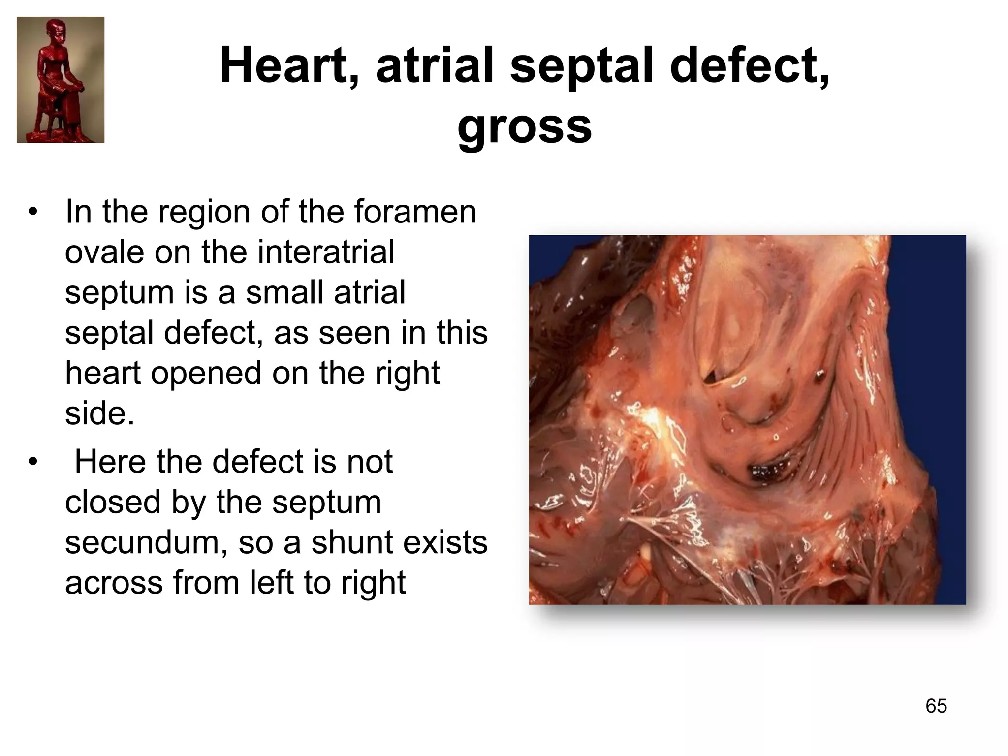 Heart, atrial septal defect,
gross
• In the region of the foramen
ovale on the interatrial
septum is a small atrial
septal defect, as seen in this
heart opened on the right
side.
• Here the defect is not
closed by the septum
secundum, so a shunt exists
across from left to right

65

 