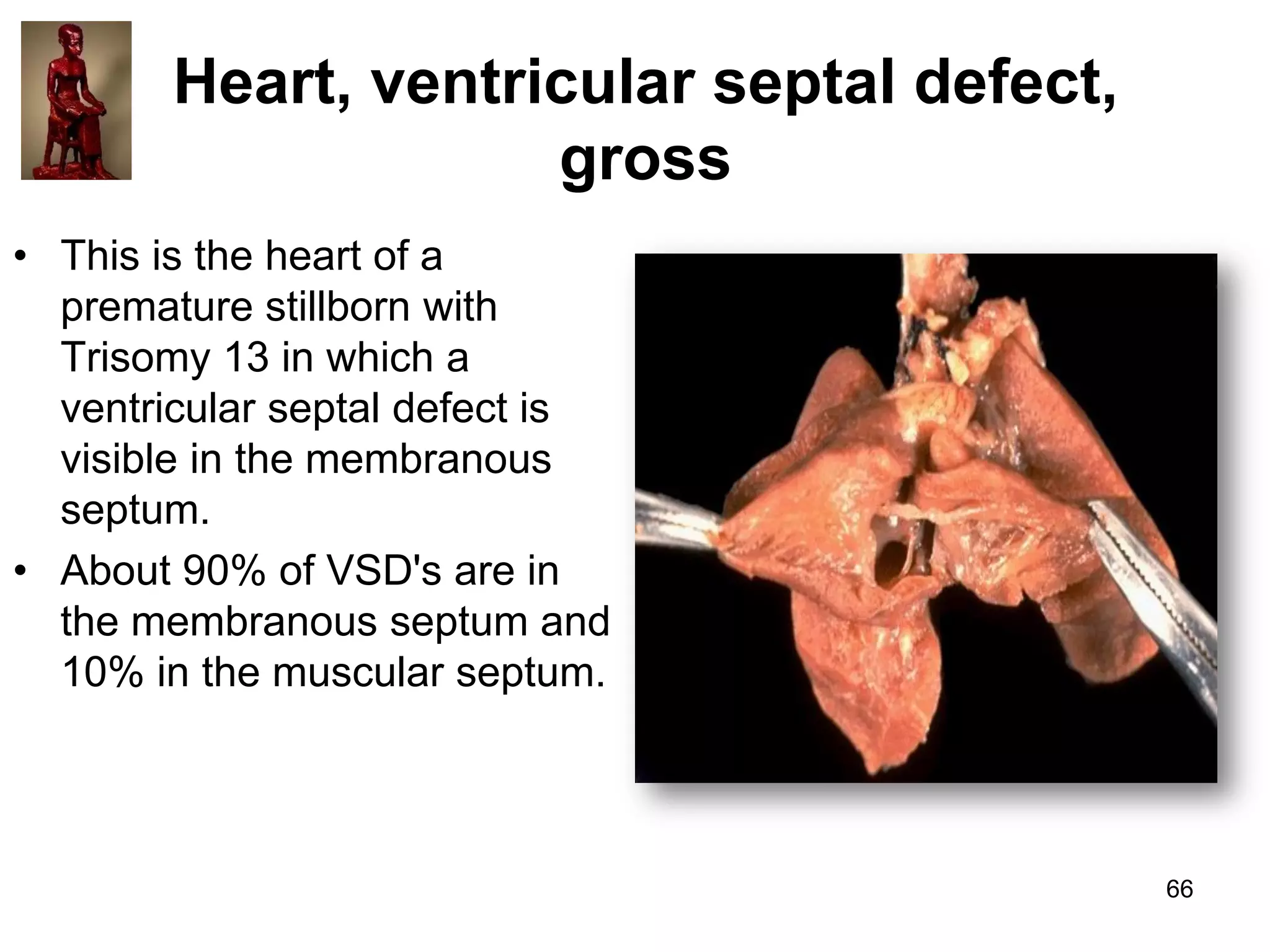 Heart, ventricular septal defect,
gross
• This is the heart of a
premature stillborn with
Trisomy 13 in which a
ventricular septal defect is
visible in the membranous
septum.
• About 90% of VSD's are in
the membranous septum and
10% in the muscular septum.

66

 