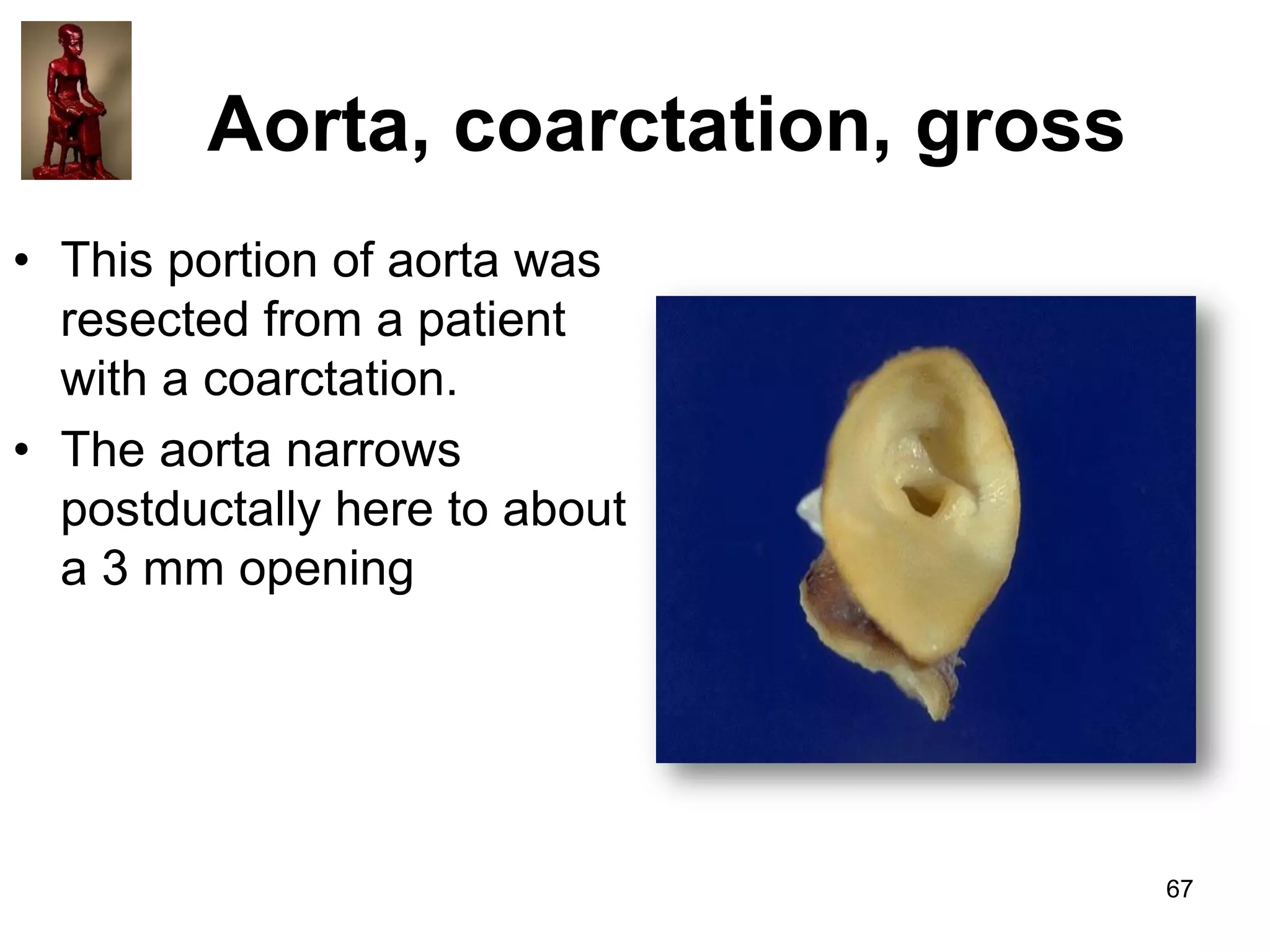 Aorta, coarctation, gross
• This portion of aorta was
resected from a patient
with a coarctation.
• The aorta narrows
postductally here to about
a 3 mm opening

67

 