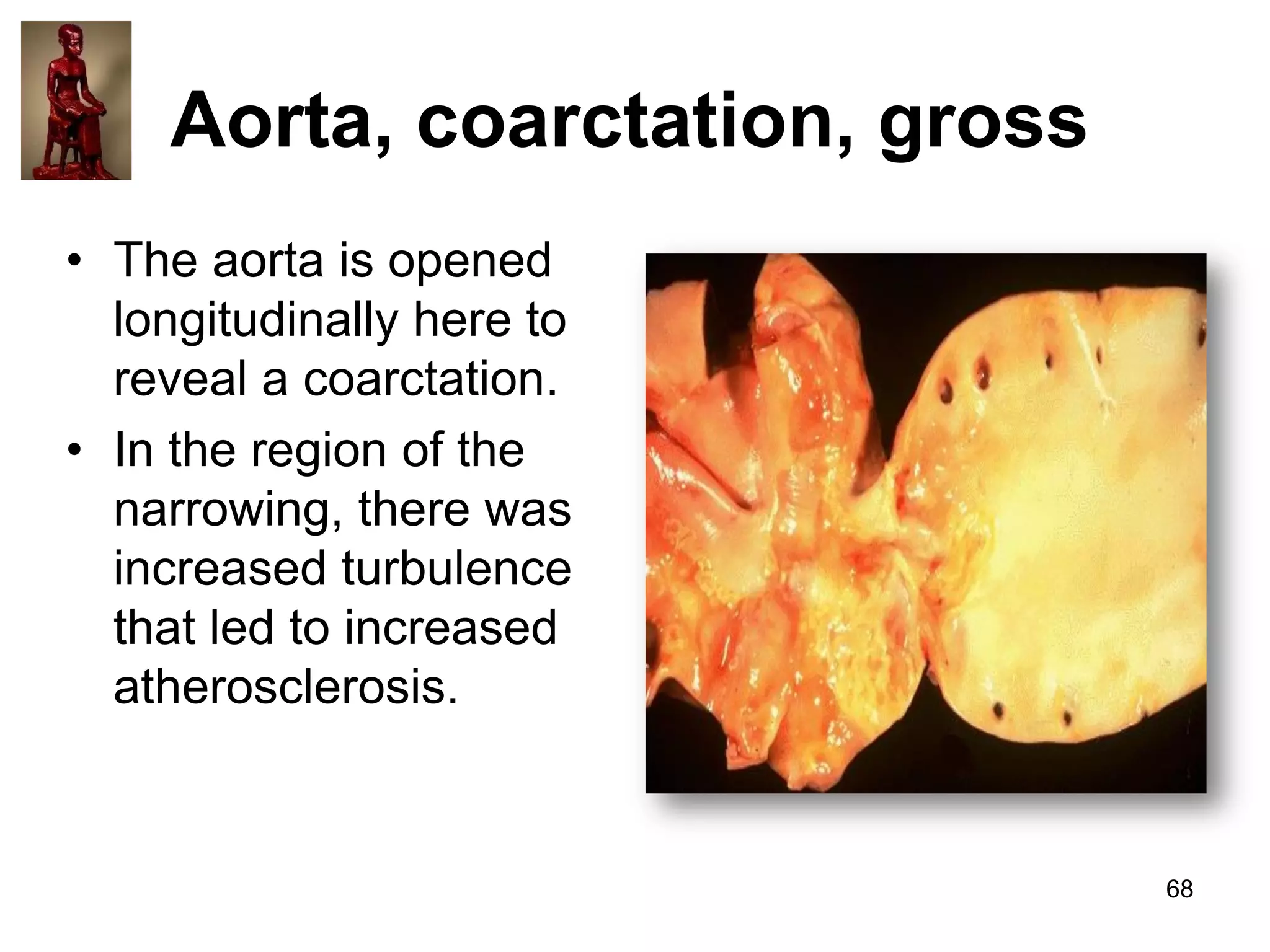 Aorta, coarctation, gross
• The aorta is opened
longitudinally here to
reveal a coarctation.
• In the region of the
narrowing, there was
increased turbulence
that led to increased
atherosclerosis.

68

 
