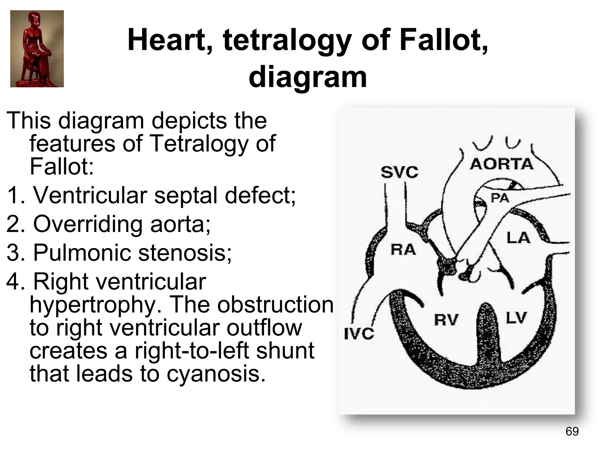 Heart, tetralogy of Fallot,
diagram
This diagram depicts the
features of Tetralogy of
Fallot:
1. Ventricular septal defect;
2. Overriding aorta;
3. Pulmonic stenosis;
4. Right ventricular
hypertrophy. The obstruction
to right ventricular outflow
creates a right-to-left shunt
that leads to cyanosis.
69

 