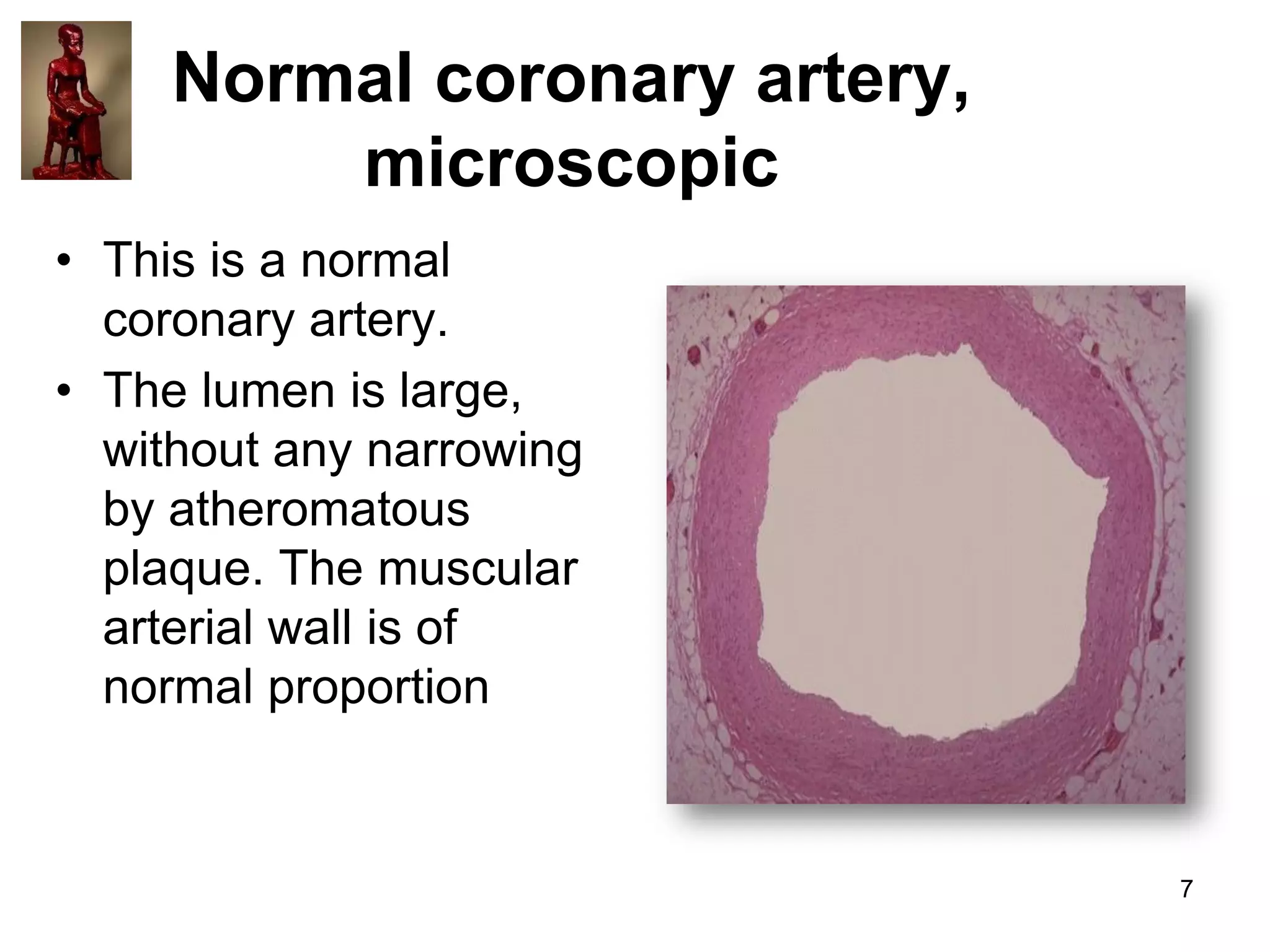 Normal coronary artery,
microscopic
• This is a normal
coronary artery.
• The lumen is large,
without any narrowing
by atheromatous
plaque. The muscular
arterial wall is of
normal proportion

7

 