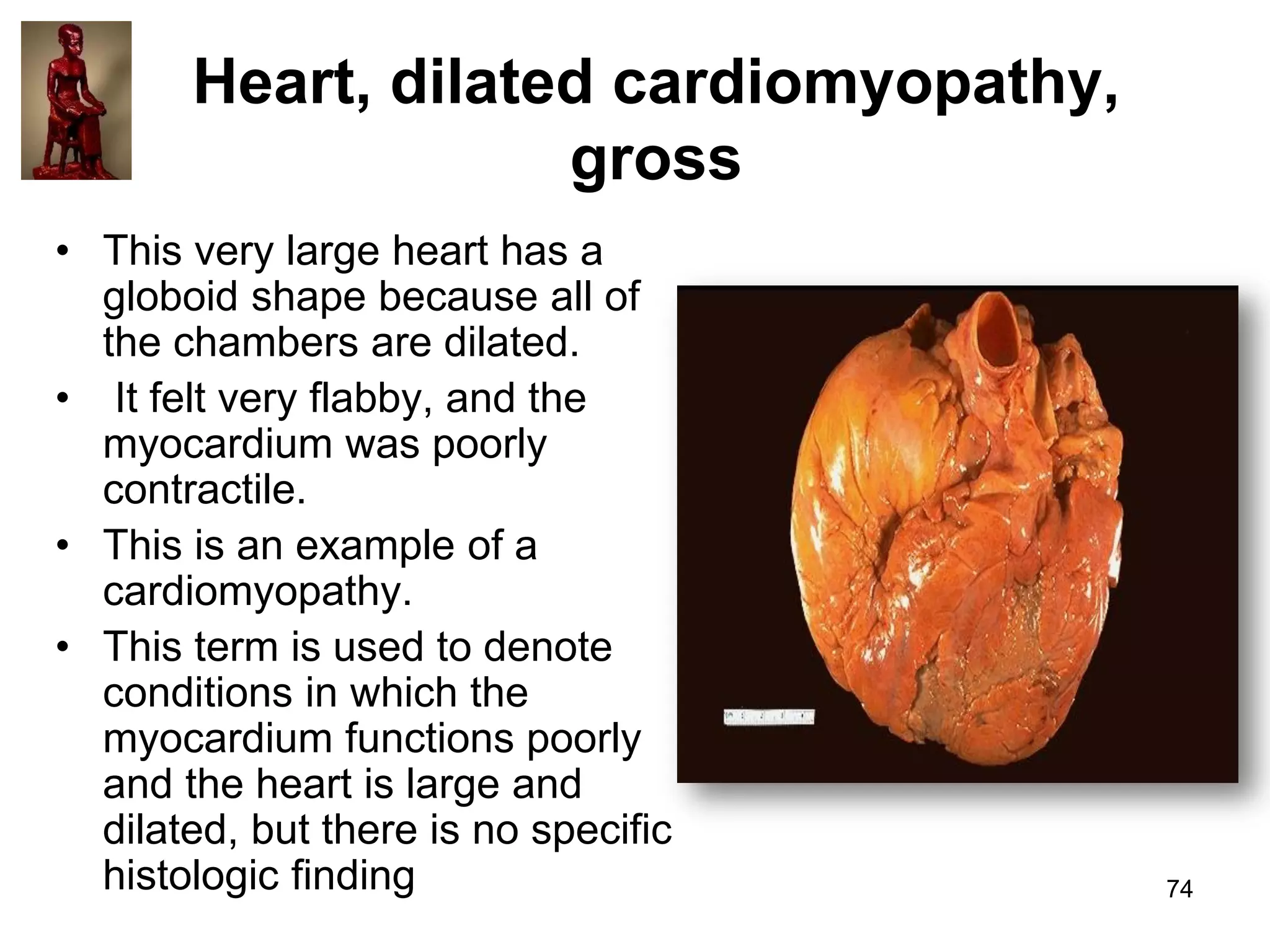 Heart, dilated cardiomyopathy,
gross
• This very large heart has a
globoid shape because all of
the chambers are dilated.
• It felt very flabby, and the
myocardium was poorly
contractile.
• This is an example of a
cardiomyopathy.
• This term is used to denote
conditions in which the
myocardium functions poorly
and the heart is large and
dilated, but there is no specific
histologic finding

74

 