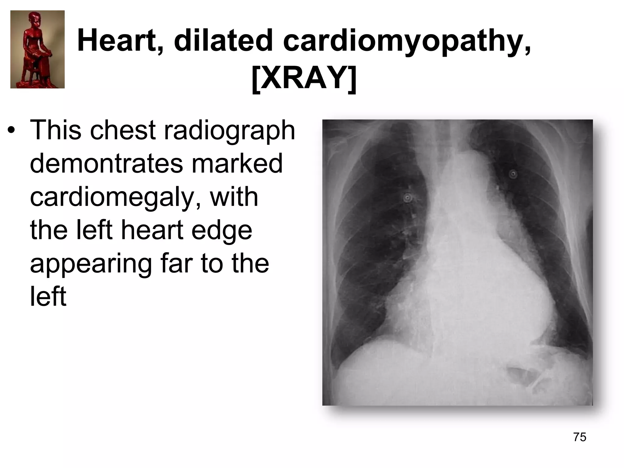Heart, dilated cardiomyopathy,
[XRAY]
• This chest radiograph
demontrates marked
cardiomegaly, with
the left heart edge
appearing far to the
left

75

 
