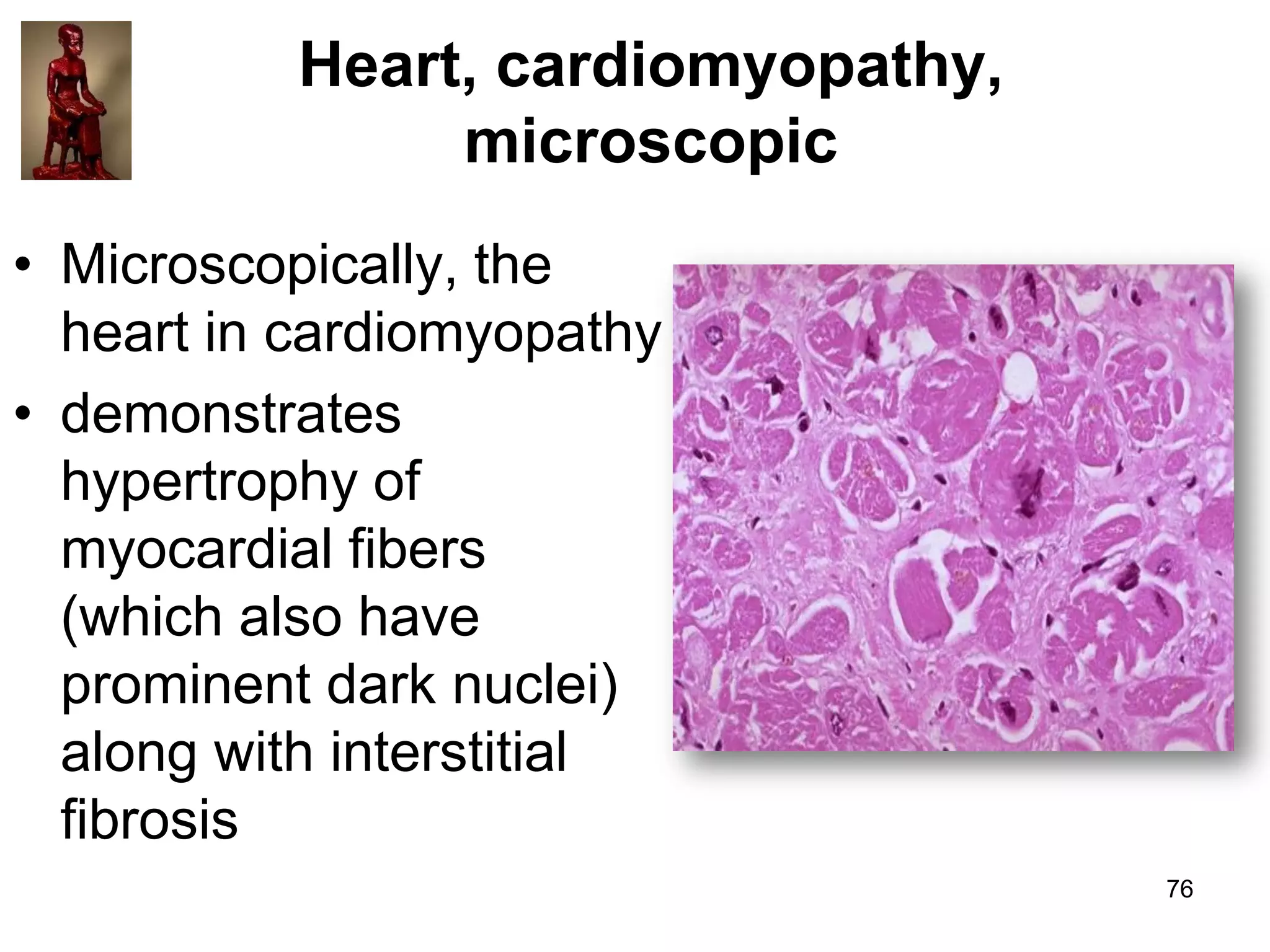 Heart, cardiomyopathy,
microscopic
• Microscopically, the
heart in cardiomyopathy
• demonstrates
hypertrophy of
myocardial fibers
(which also have
prominent dark nuclei)
along with interstitial
fibrosis
76

 