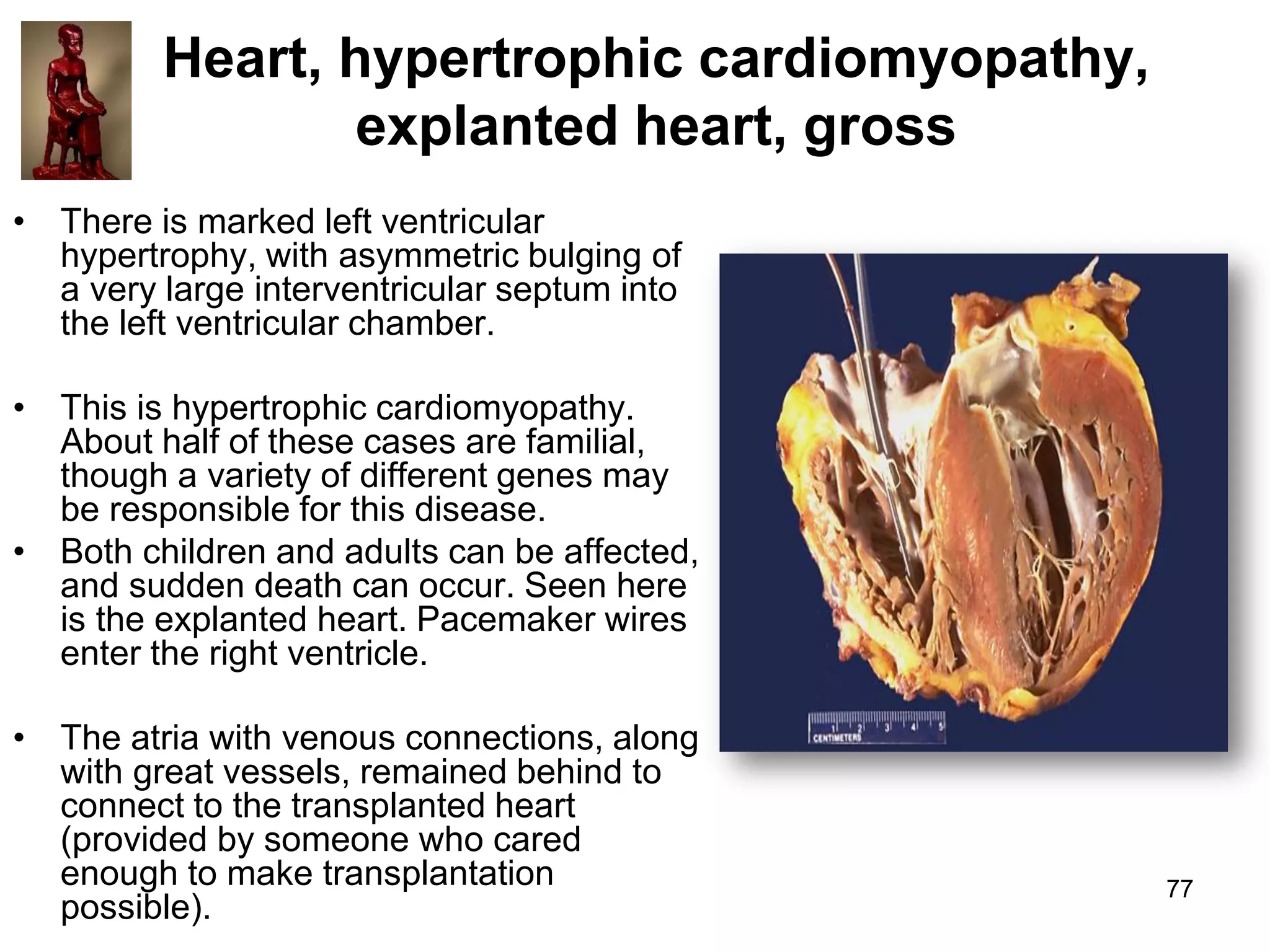 Heart, hypertrophic cardiomyopathy,
explanted heart, gross
• There is marked left ventricular
hypertrophy, with asymmetric bulging of
a very large interventricular septum into
the left ventricular chamber.
• This is hypertrophic cardiomyopathy.
About half of these cases are familial,
though a variety of different genes may
be responsible for this disease.
• Both children and adults can be affected,
and sudden death can occur. Seen here
is the explanted heart. Pacemaker wires
enter the right ventricle.
• The atria with venous connections, along
with great vessels, remained behind to
connect to the transplanted heart
(provided by someone who cared
enough to make transplantation
possible).

77

 
