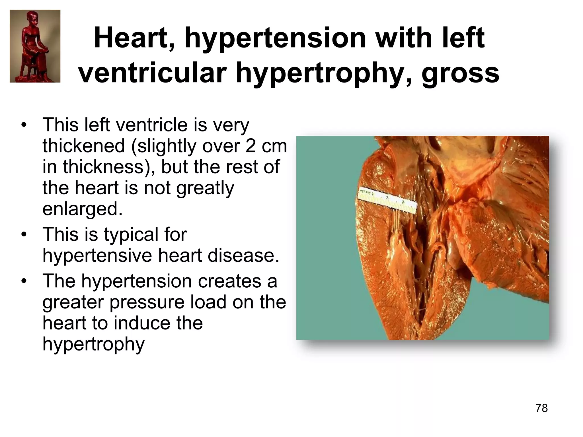 Heart, hypertension with left
ventricular hypertrophy, gross
• This left ventricle is very
thickened (slightly over 2 cm
in thickness), but the rest of
the heart is not greatly
enlarged.
• This is typical for
hypertensive heart disease.
• The hypertension creates a
greater pressure load on the
heart to induce the
hypertrophy

78

 