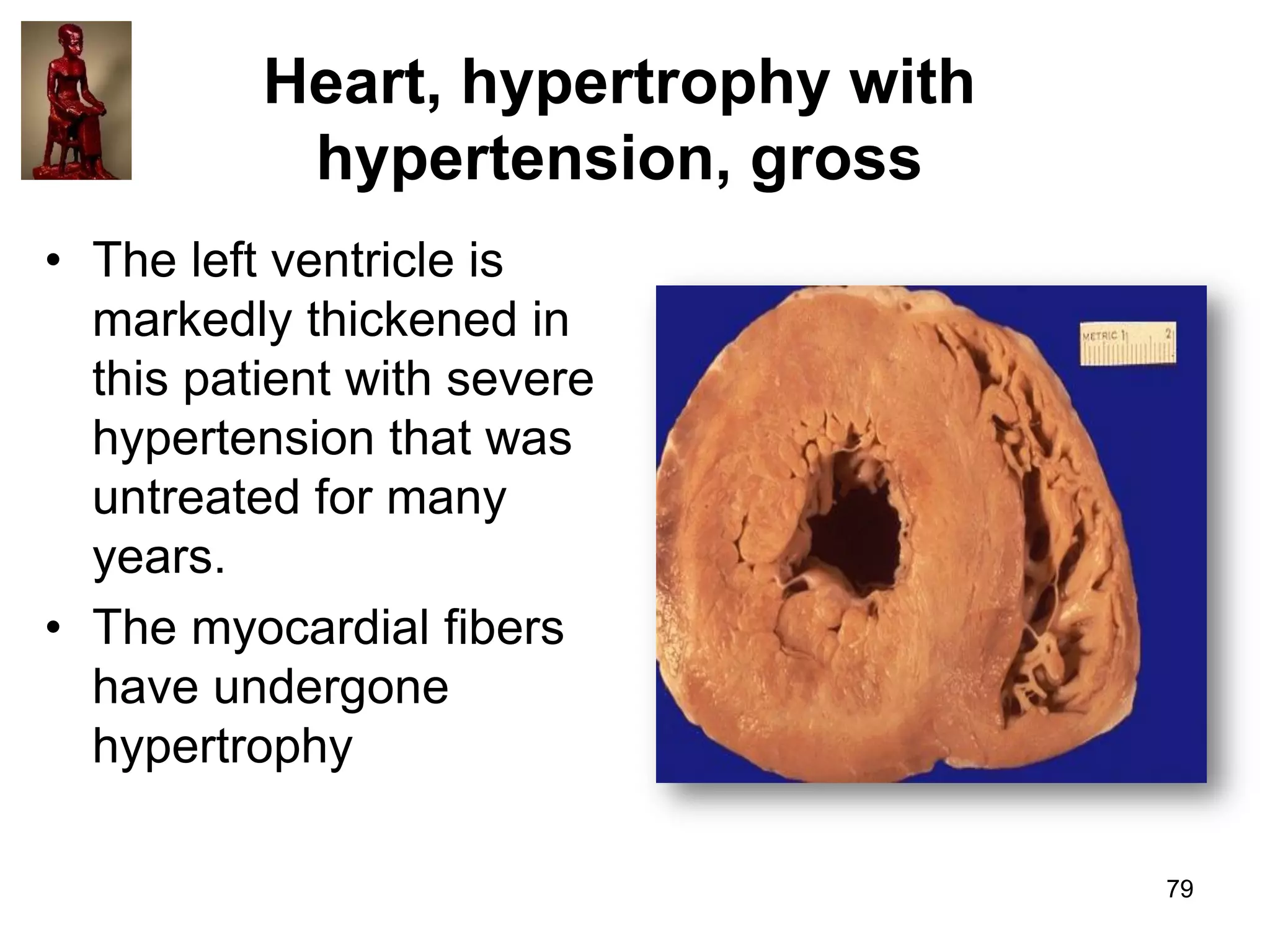 Heart, hypertrophy with
hypertension, gross
• The left ventricle is
markedly thickened in
this patient with severe
hypertension that was
untreated for many
years.
• The myocardial fibers
have undergone
hypertrophy
79

 