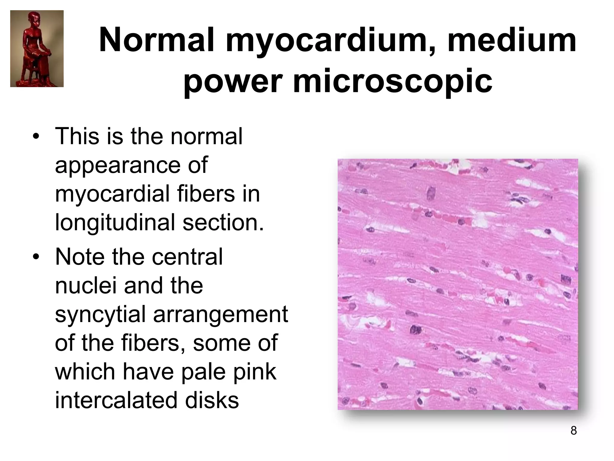 Normal myocardium, medium
power microscopic
• This is the normal
appearance of
myocardial fibers in
longitudinal section.
• Note the central
nuclei and the
syncytial arrangement
of the fibers, some of
which have pale pink
intercalated disks
8

 