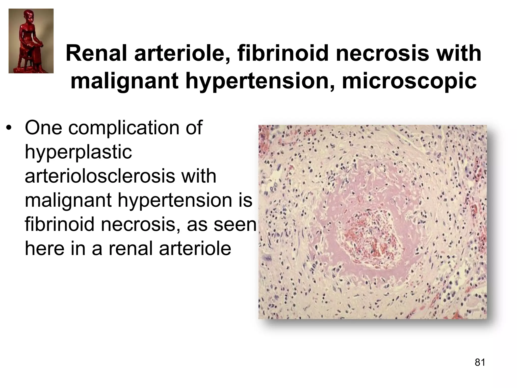 Renal arteriole, fibrinoid necrosis with
malignant hypertension, microscopic
• One complication of
hyperplastic
arteriolosclerosis with
malignant hypertension is
fibrinoid necrosis, as seen
here in a renal arteriole

81

 