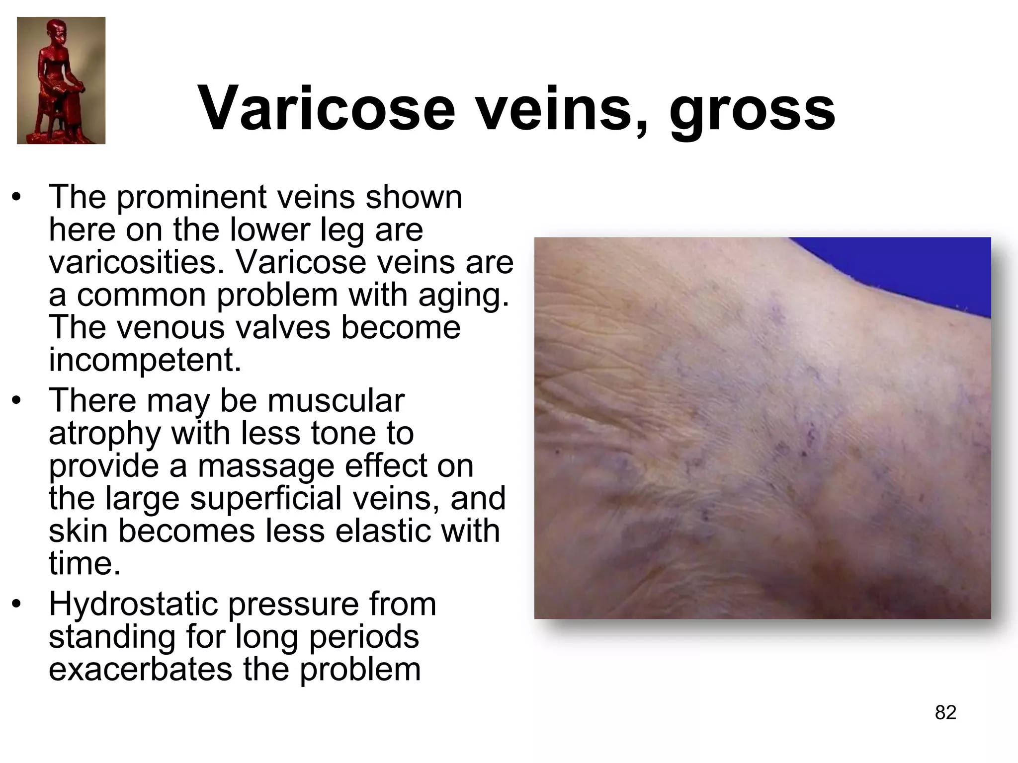 Varicose veins, gross
• The prominent veins shown
here on the lower leg are
varicosities. Varicose veins are
a common problem with aging.
The venous valves become
incompetent.
• There may be muscular
atrophy with less tone to
provide a massage effect on
the large superficial veins, and
skin becomes less elastic with
time.
• Hydrostatic pressure from
standing for long periods
exacerbates the problem
82

 