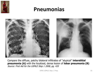 Pneumonias
IVMS USMLE Step 1 Prep. 10
Compare the diffuse, patchy bilateral infiltrates of “atypical” interstitial
pneumonia (A) with the localized, dense lesion of lobar pneumonia (B)
Source: First Aid for the USMLE Step 1 2008, pg. 435
 