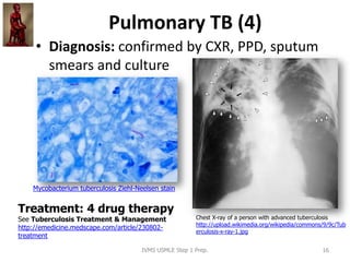 Pulmonary TB (4)
• Diagnosis: confirmed by CXR, PPD, sputum
smears and culture
Chest X-ray of a person with advanced tuber...