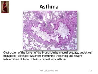 Asthma
Obstruction of the lumen of the bronchiole by mucoid exudate, goblet cell
metaplasia, epithelial basement membrane thickening and severe
inflammation of bronchiole in a patient with asthma.
IVMS USMLE Step 1 Prep. 29
 