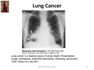 Lung Cancer
IVMS USMLE Step 1 Prep. 41
Squamous cell carcinoma in the right lower lobe
Source: First Aid for the USMLE Step 1 2008, pg. 434
Lung cancer is a leading cause of cancer death. Presentation:
cough, hemoptysis, bronchial obstruction, wheezing, pneumonic
“coin” lesion on x-ray film
 