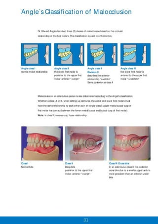 Ivoclar class 2_and_class_3_bites