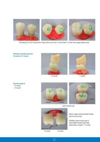 Ivoclar class 2_and_class_3_bites