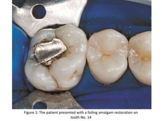 Figure 1: The patient presented with a failing amalgam restoration on
tooth No. 14
 
