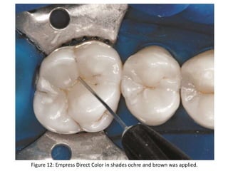 Figure 12: Empress Direct Color in shades ochre and brown was applied.