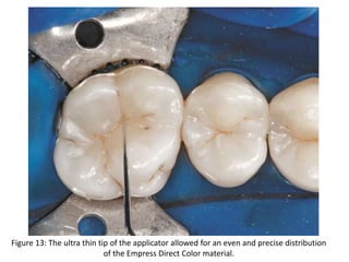 Figure 13: The ultra thin tip of the applicator allowed for an even and precise distribution
of the Empress Direct Color material.