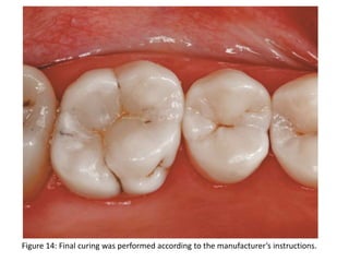 Figure 14: Final curing was performed according to the manufacturer’s instructions.