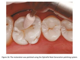 Figure 16: The restoration was polished using the OptraPol Next Generation polishing system.