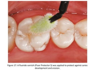 Figure 17: A fluoride varnish (Fluor Protector S) was applied to protect against caries
development and erosion.