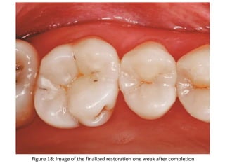 Figure 18: Image of the finalized restoration one week after completion.