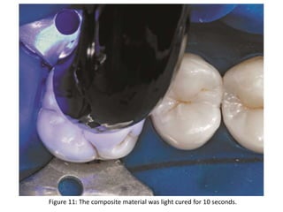 Figure 11: The composite material was light cured for 10 seconds.
 