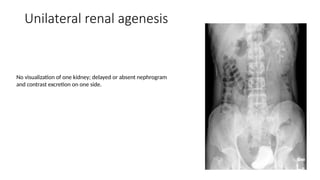 Intravenoupyelonephrogramcomphrensive.pptx