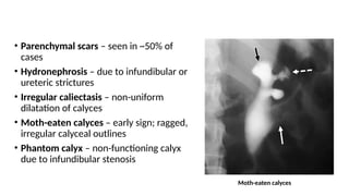 Intravenoupyelonephrogramcomphrensive.pptx