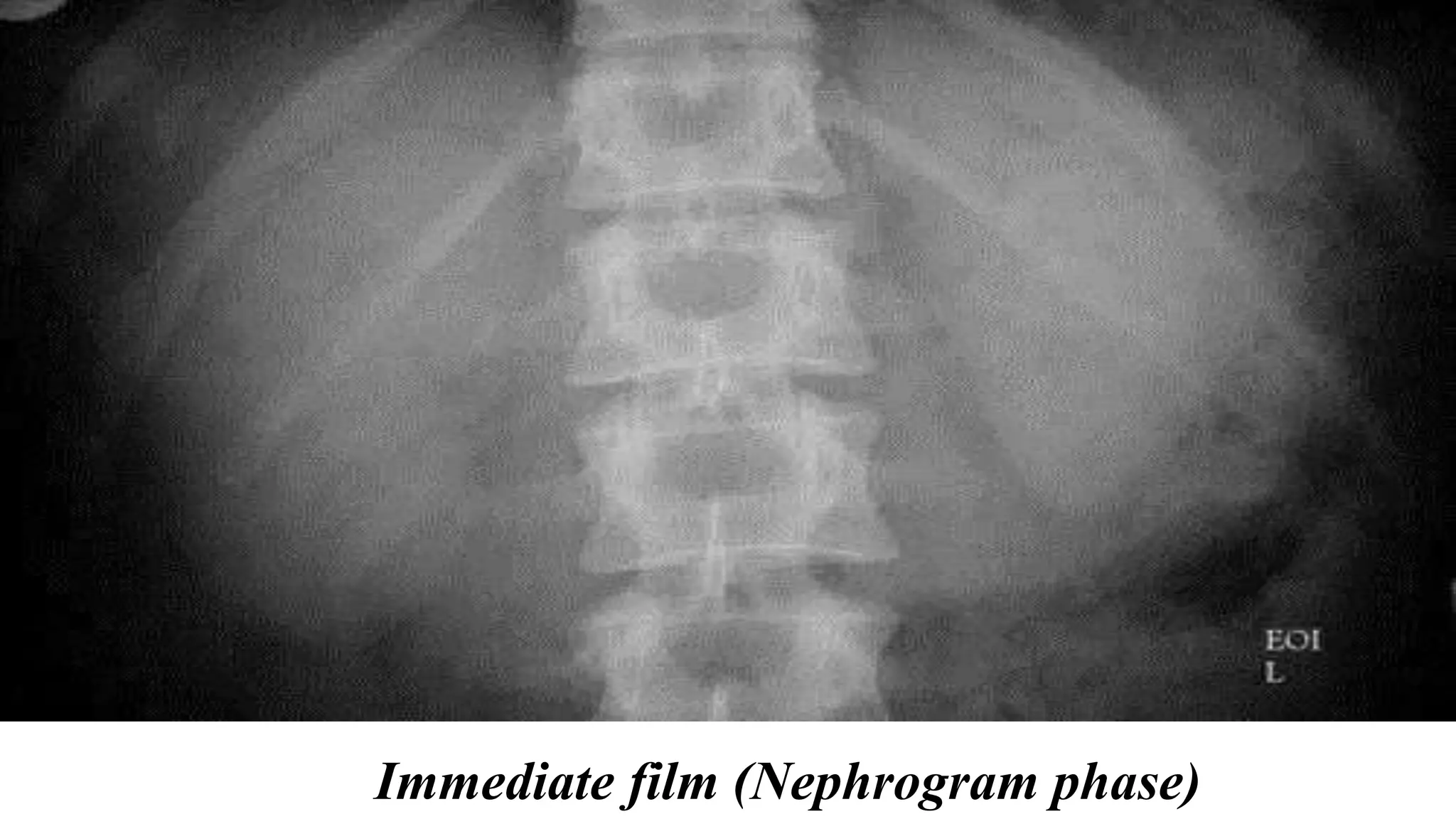 Immediate film (Nephrogram phase)
 