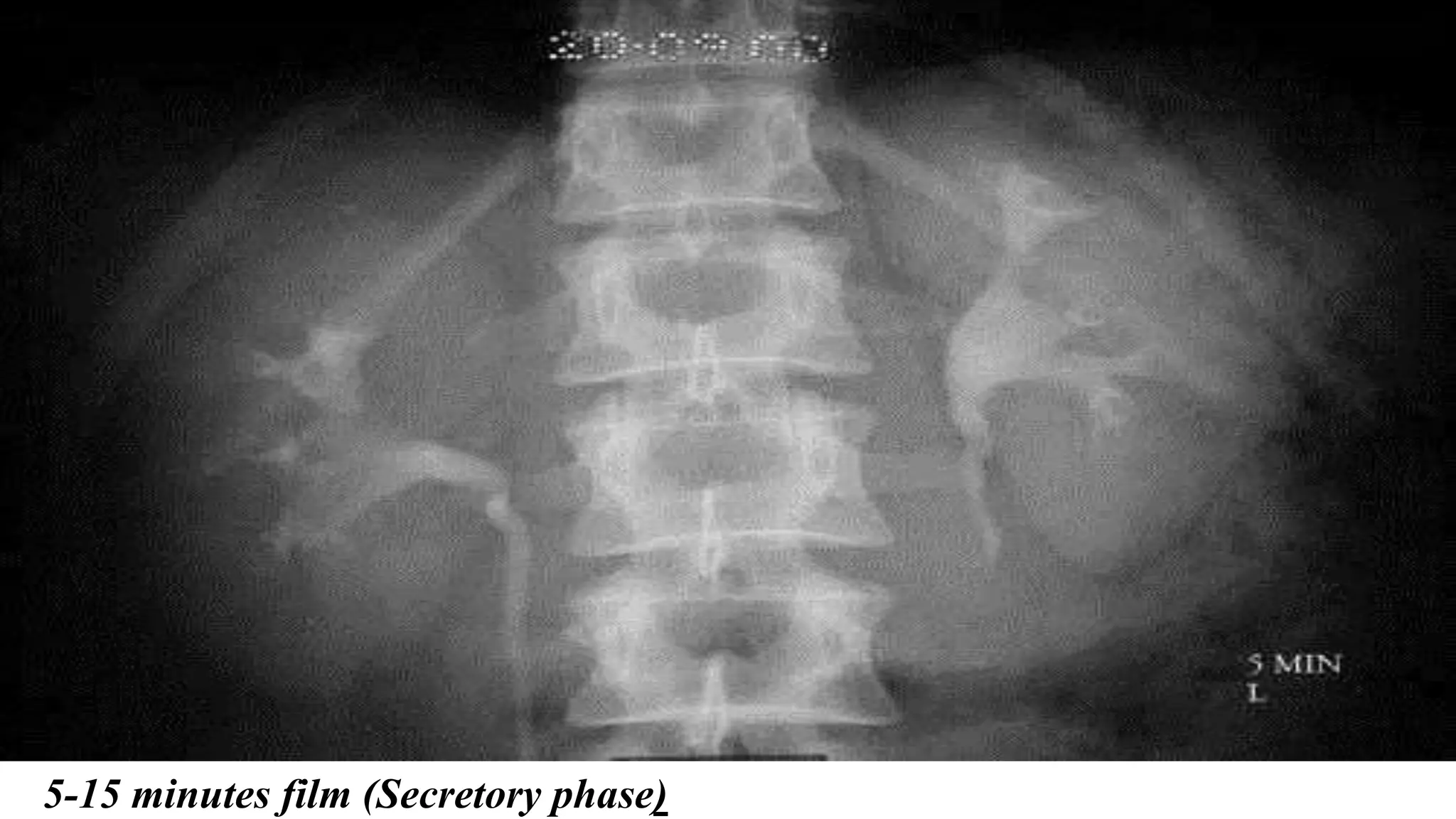 5-15 minutes film (Secretory phase)
 