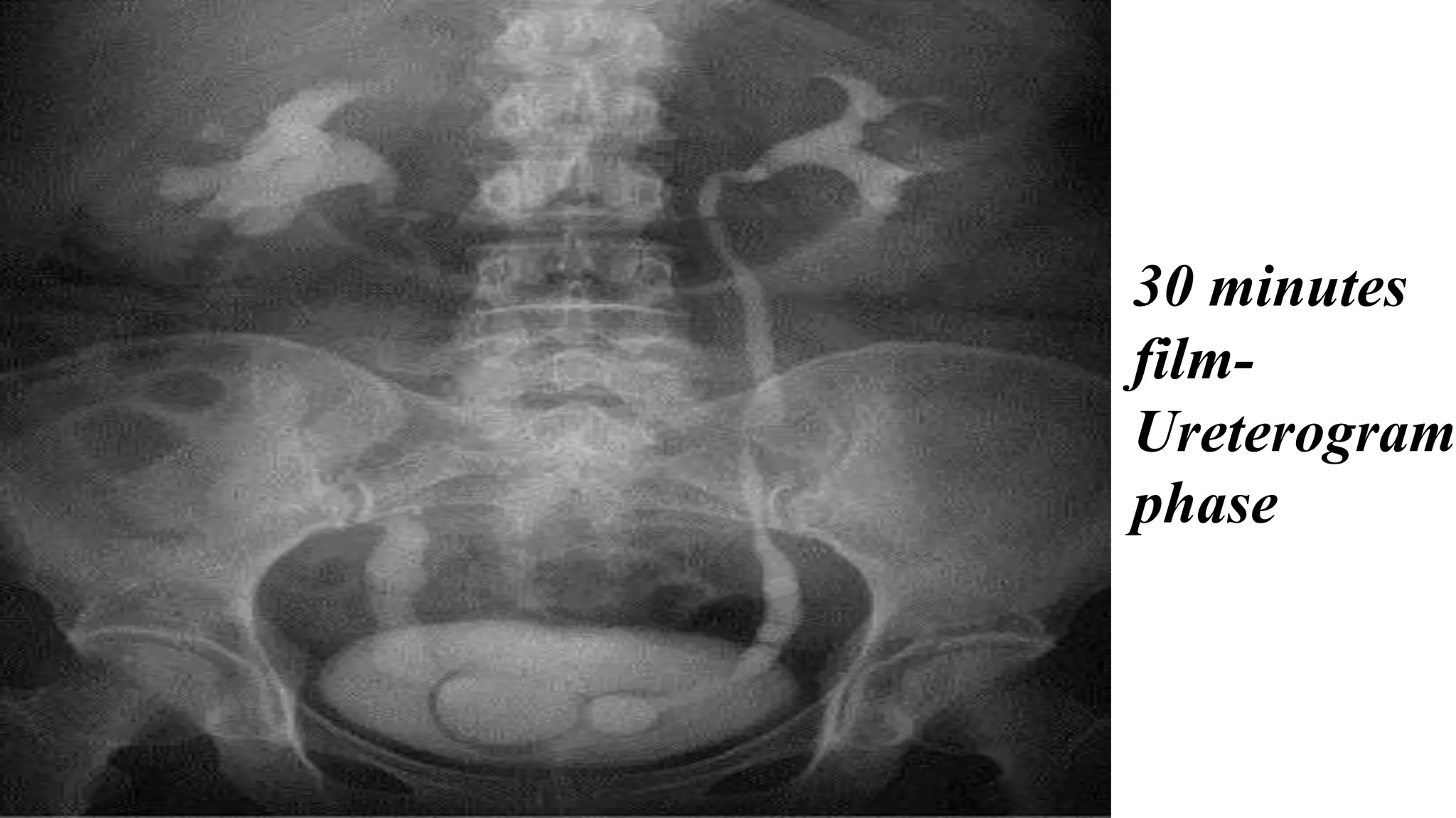 30 minutes
film-
Ureterogram
phase
 