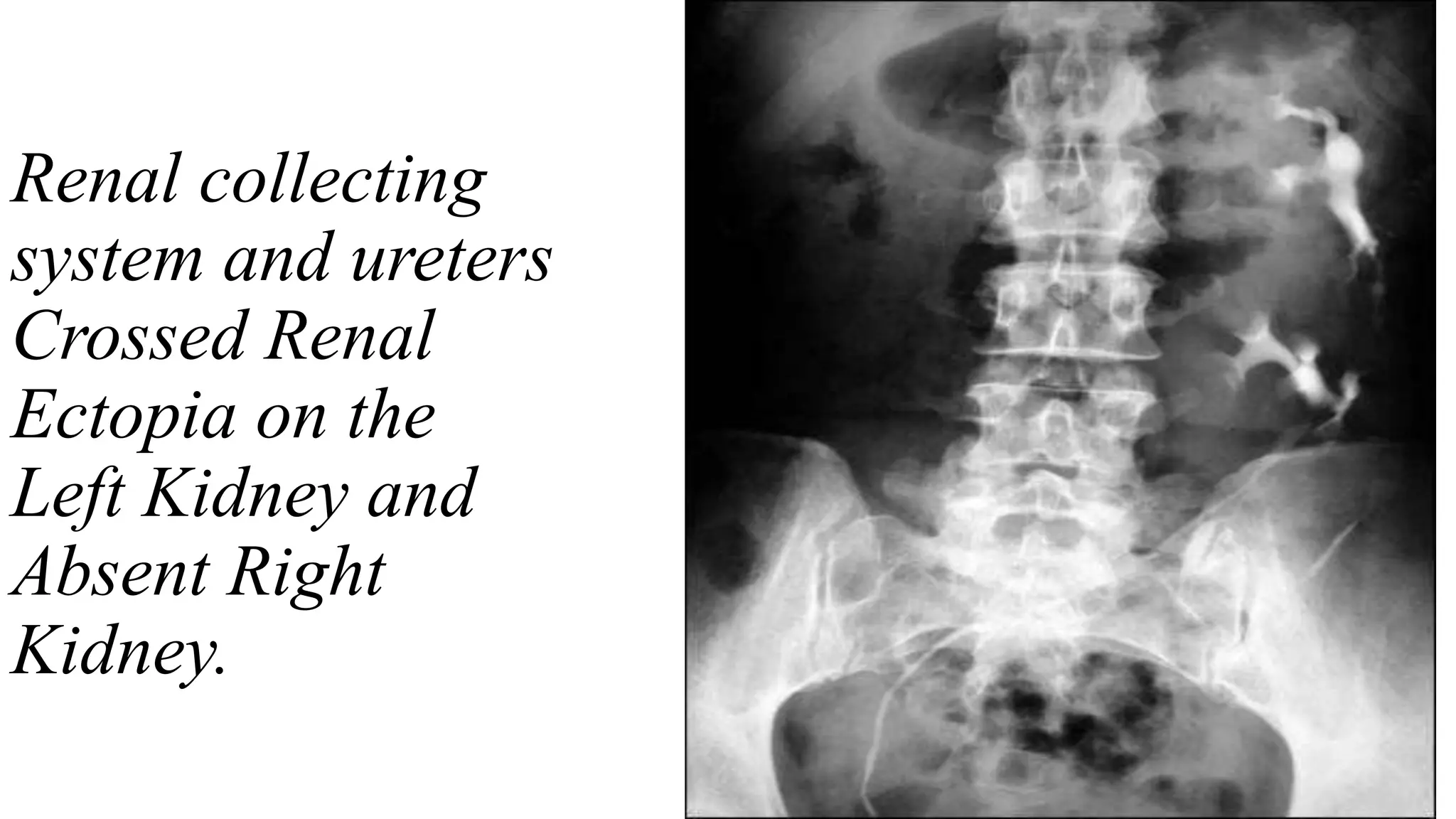 Renal collecting
system and ureters
Crossed Renal
Ectopia on the
Left Kidney and
Absent Right
Kidney.
 