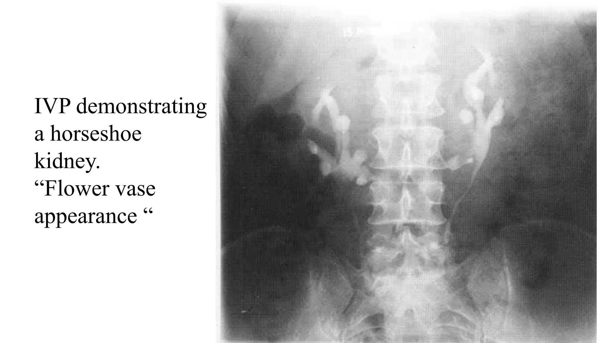 IVP demonstrating
a horseshoe
kidney.
“Flower vase
appearance “
 