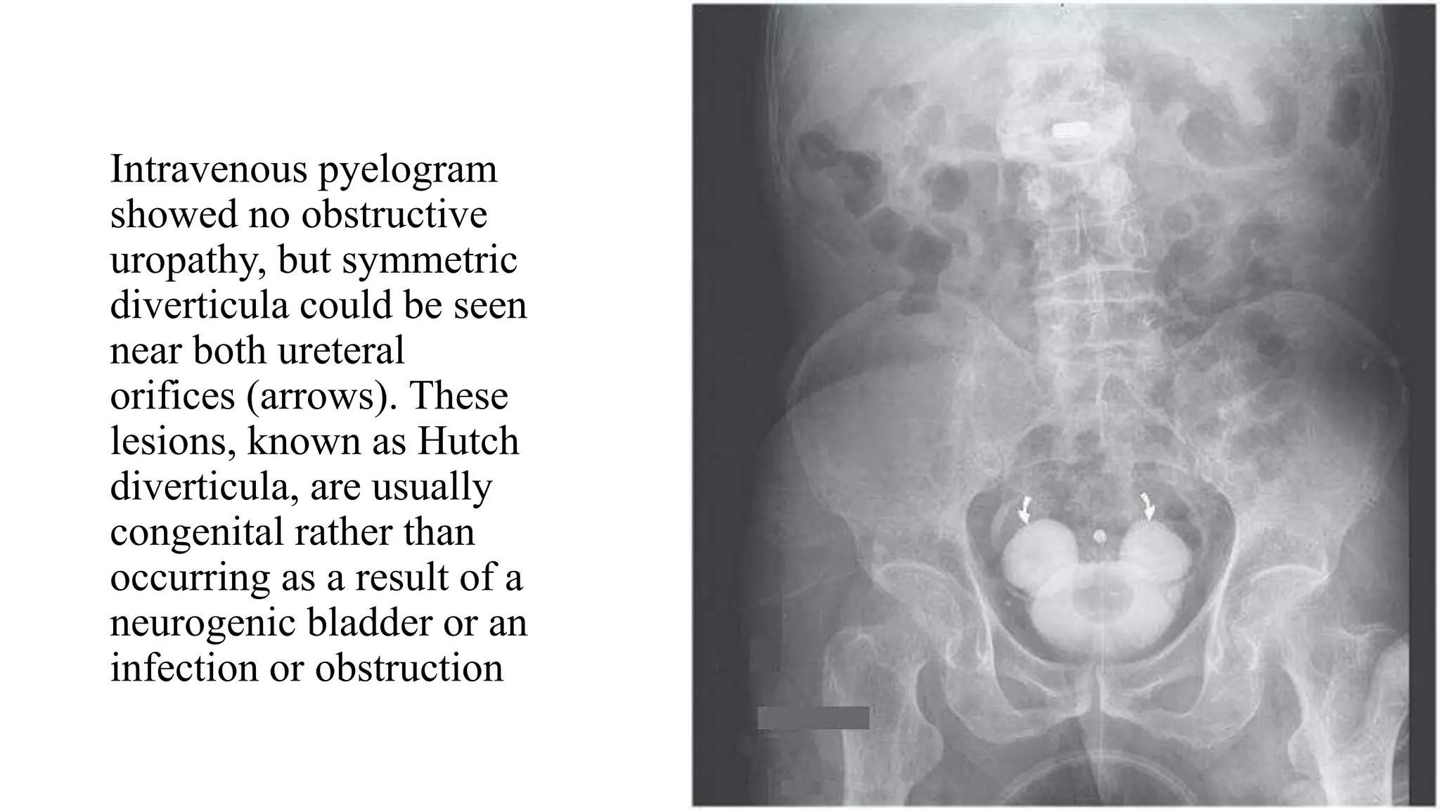 Intravenous pyelogram
showed no obstructive
uropathy, but symmetric
diverticula could be seen
near both ureteral
orifices (arrows). These
lesions, known as Hutch
diverticula, are usually
congenital rather than
occurring as a result of a
neurogenic bladder or an
infection or obstruction
 