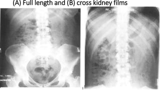 (A) Full length and (B) cross kidney films
 