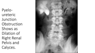 Pyelo-
ureteric
Junction
Obstruction
Shows as
Dilation of
Right Renal
Pelvis and
Calyces.
 