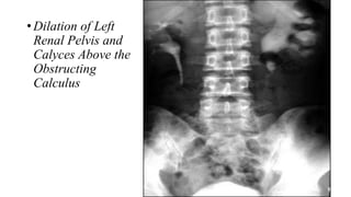 • Dilation of Left
Renal Pelvis and
Calyces Above the
Obstructing
Calculus
 