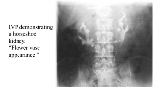 IVP demonstrating
a horseshoe
kidney.
“Flower vase
appearance “
 
