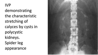 IVP
demonstrating
the characteristic
stretching of
calyces by cysts in
polycystic
kidneys.
Spider leg
appearance
 